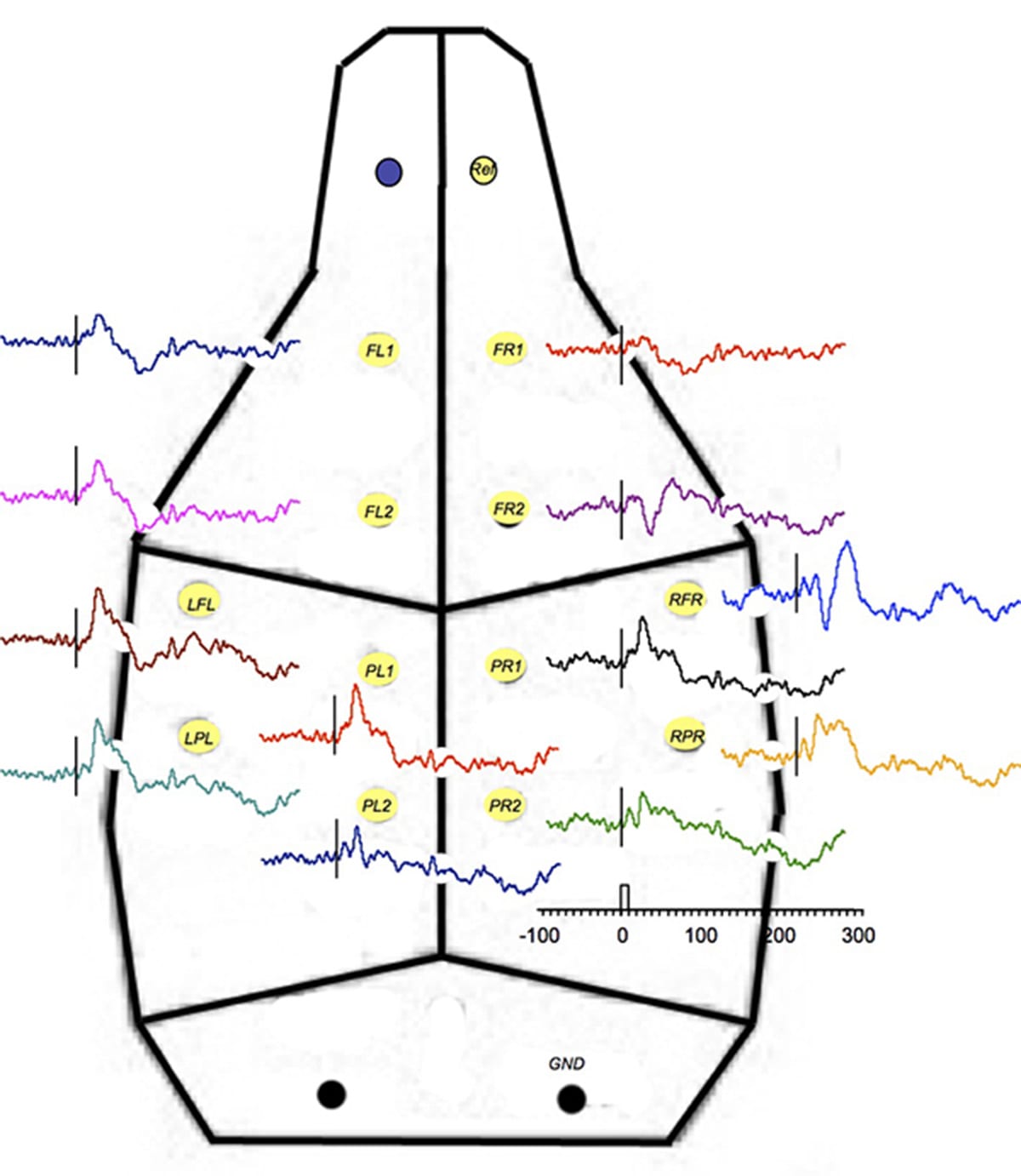 Cortical Sensory Evoked Potentials - Melior Discovery